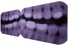 Photo of Рентген зубов и челюсти