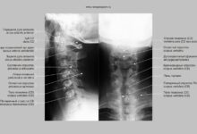 Photo of Рентген позвоночника в профиле