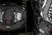 Photo of КТ грудной клетки для диагностики опухолей