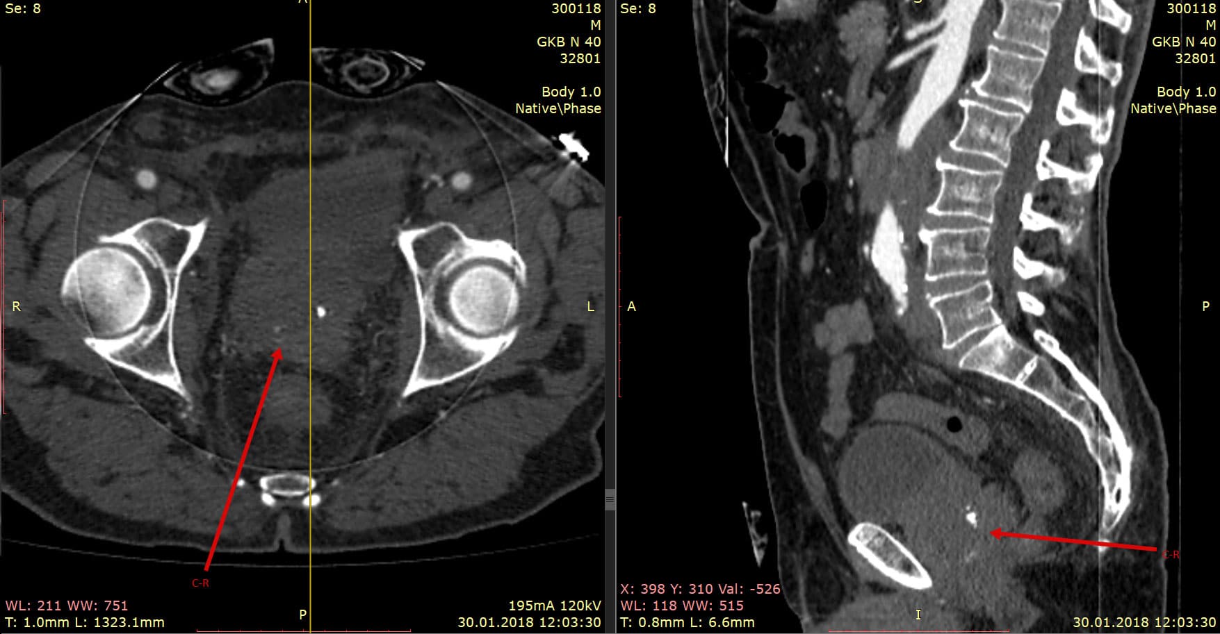 Фото 9 — КТ грудной клетки для диагностики опухолей