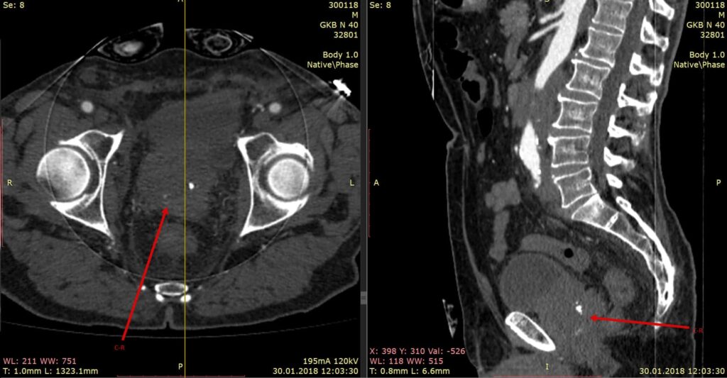 Фото 15 — КТ брюшной полости с контрастом