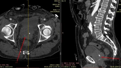 Photo of КТ брюшной полости с контрастом