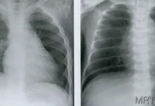Photo of Рентген легких в двух проекциях