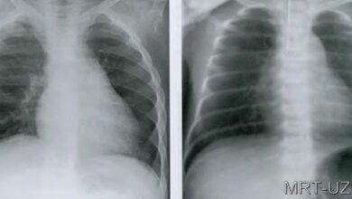 Photo of Рентген легких в двух проекциях