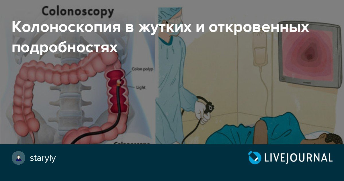 Фото 22 — Кольоноскопия для обследования кишечника