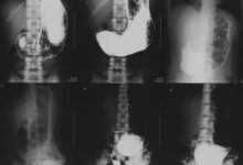 Photo of Гастроэнтероскопия для исследования ЖКТ