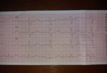 Photo of ЭКГ с записью кардиограммы