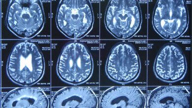 Photo of МРТ головного мозга с ангиографией