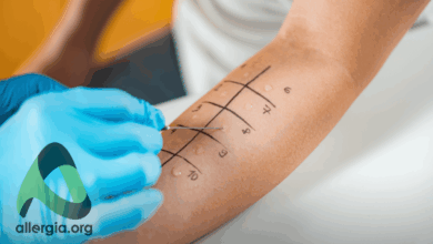 Photo of Диагностика аллергических реакций