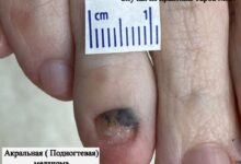 Photo of Диагностика рака кожи