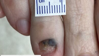 Photo of Диагностика рака кожи
