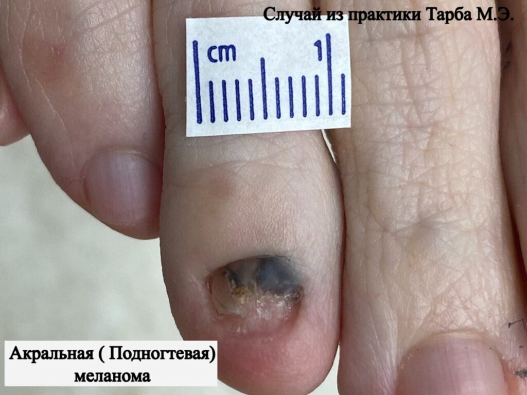 Фото 24 — Диагностика рака кожи