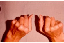 Photo of Профилактика и лечение ревматоидного артрита