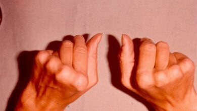 Photo of Профилактика и лечение ревматоидного артрита