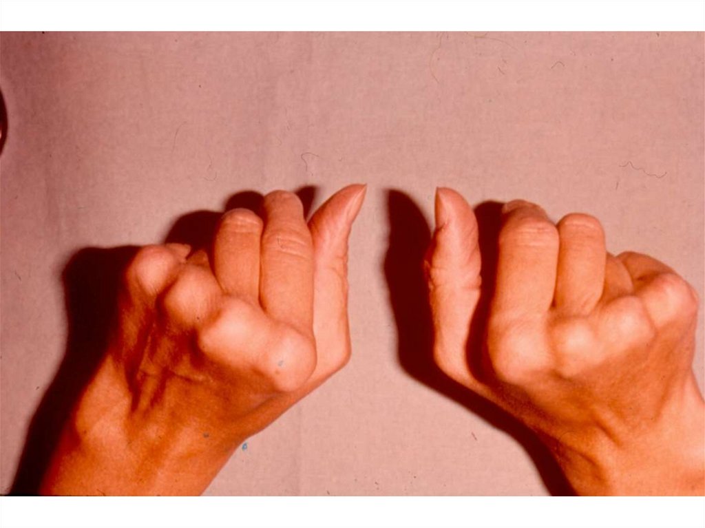 Фото 29 — Профилактика и лечение ревматоидного артрита