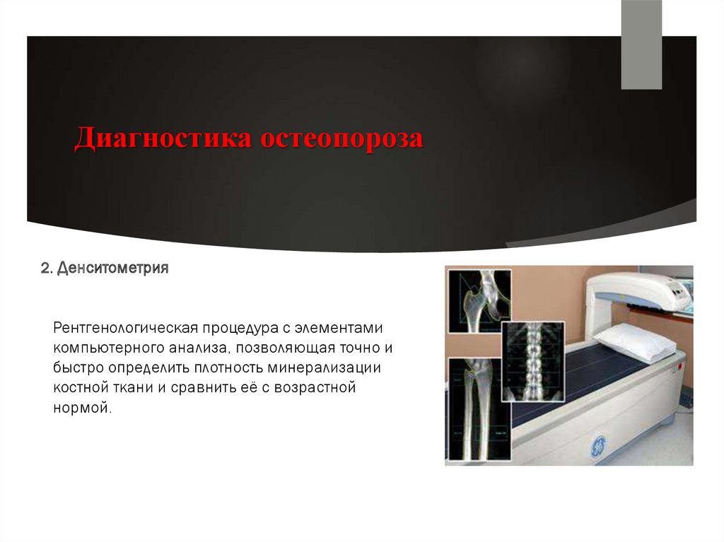 Фото 55 — Диагностика остеопороза у пожилых