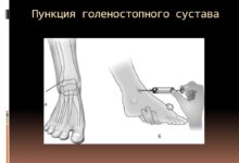 Photo of Пункция сустава для анализа синовиальной жидкости