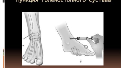 Photo of Пункция сустава для анализа синовиальной жидкости