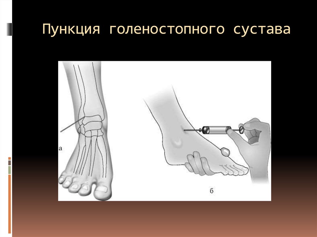 Фото 16 — Пункция сустава для анализа синовиальной жидкости