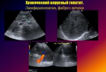 Photo of Диагностика заболеваний печени