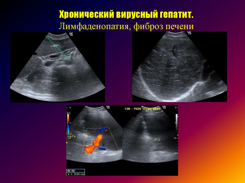 Фото 31 — Диагностика заболеваний печени