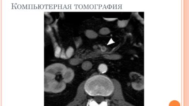 Photo of Диагностика тромбоза кровеносных сосудов